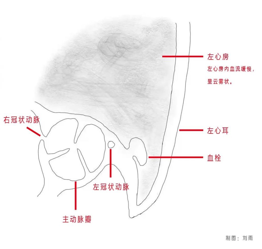 在下图可以看到,心脏规律收缩,左房及心耳内回声清晰,未见云雾影和