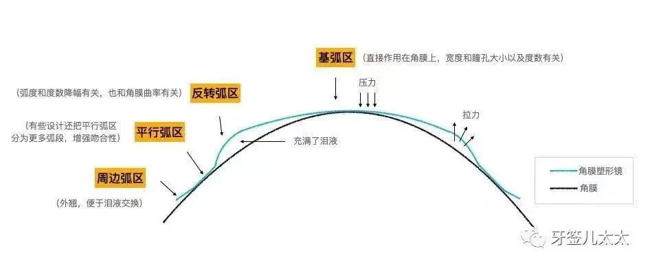 ok镜需要满足以下设计才能有效塑形:基弧区压迫角膜,反转区负压抽吸