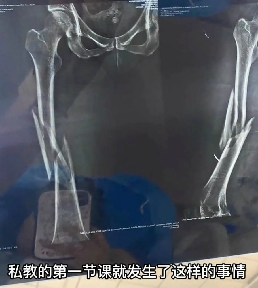 女子练瑜伽被教练压断大腿!网友:下手太狠了!