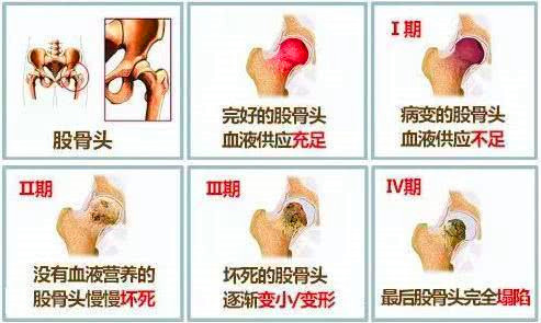 股骨头坏死还能调理好吗