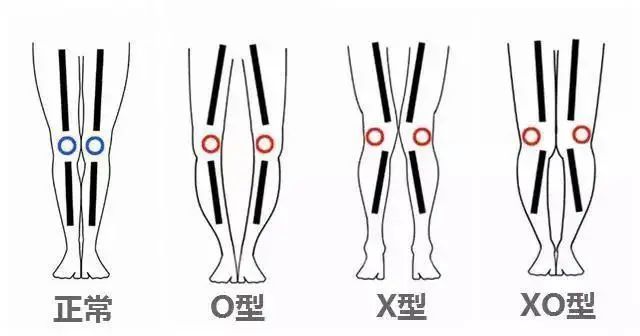 先说说腿型,常见的腿型有 正常腿型,o型腿,x型腿和xo型腿.