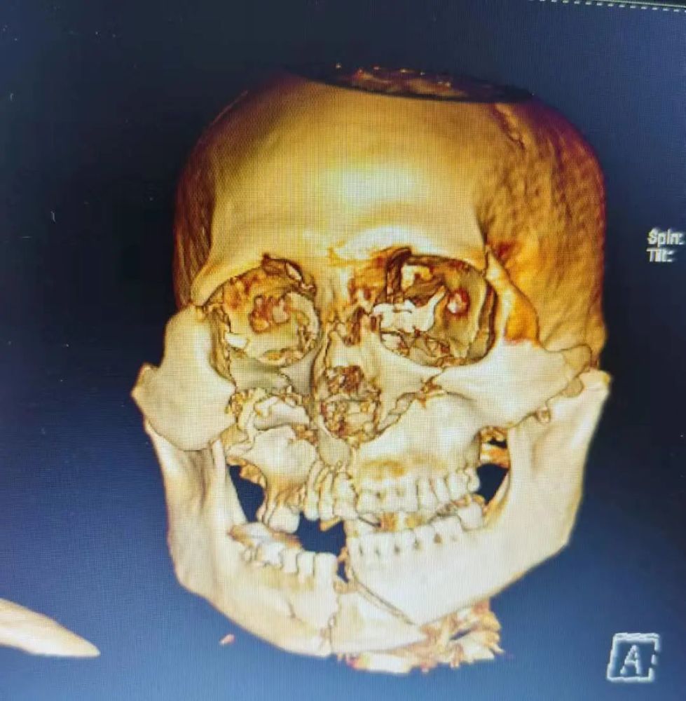全部拼接修复固定好,术后患者颌面部外伤及粉碎性骨折独立完成一例