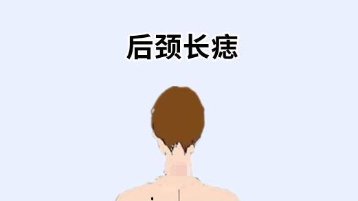 后颈长痣在相学当中,若是一个人的后颈的位置处长有恶痣,则属于典型的