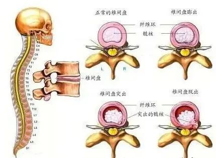 30岁不到就腰椎间盘突出是什么感觉?