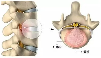 如果压力过大,膨出的椎间盘外围纤维环破裂,里面更柔软的髓核流出来了