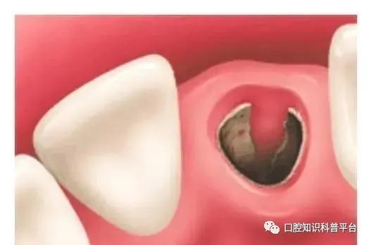 处理干槽症牙医须知:干槽症的特效处理方法填入时要将适量大小的材料