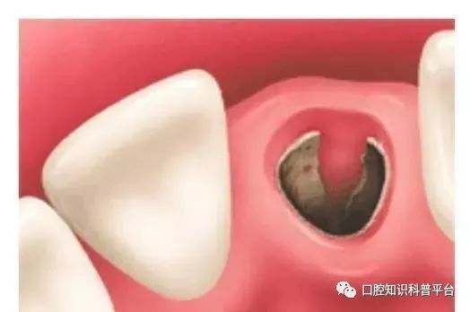 拔牙后24小时内,吸烟发生干槽症的比率高达40%,冠周炎患牙较未发生