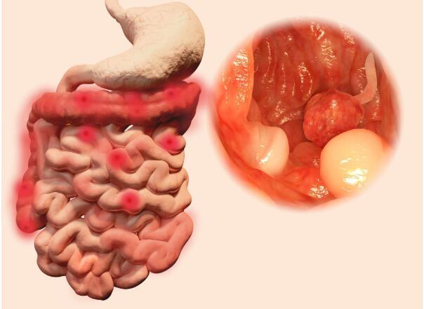 除了肛周感染外,还有一种疾病和肛门瘙痒有关,它就是大肠癌其中之一