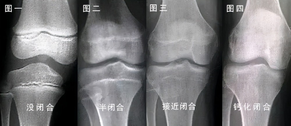 如果检测显示孩子的骨龄偏大,那则说明他们骨骼闭合的时间比较早,生长