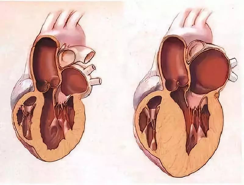 心室肥厚,心脏扩大,心力衰竭,高血压下的心脏都经历了