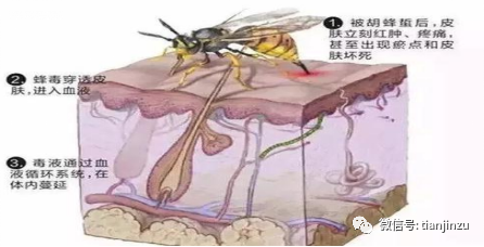 被马蜂蜇伤怎么