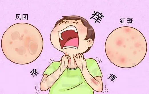 常见皮肤病荨麻疹让你痒到发狂,和哪些因素有关?