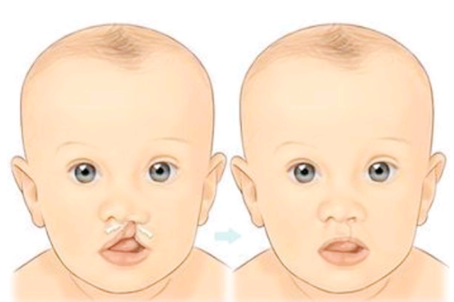 为何在孕期正常吃叶酸,胎儿还会"唇腭裂"?孕妈别耍小