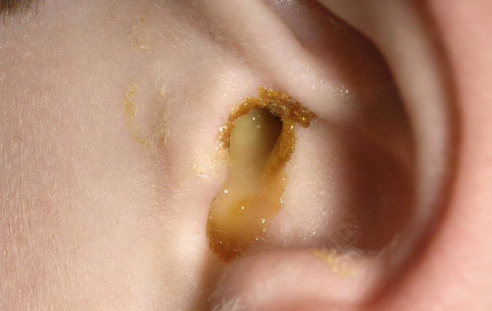 耳屎挖得太干净,外界的有害物质更容易进入耳朵,也会造成外耳道干燥