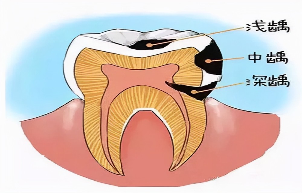 杭州美莱口腔健康科普蛀牙很久不管会有什么后果