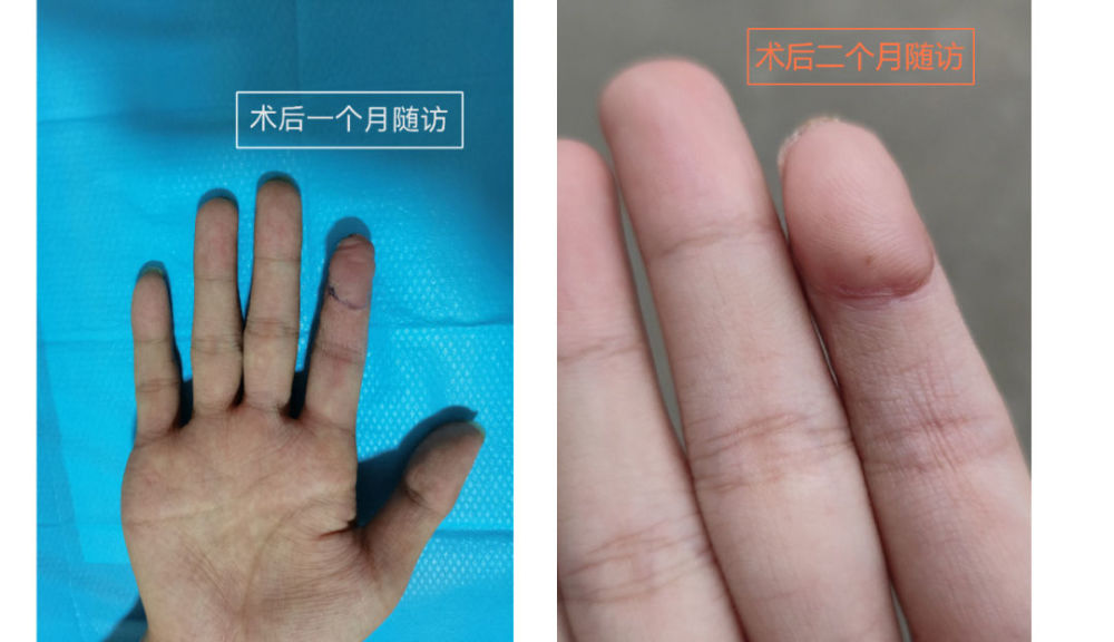 小时开展各种类型手足外伤,断指(趾,断肢再植,不同形式的拇手指再造