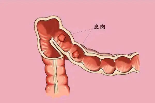 为什么肠道上会长息肉?它有什么症状呢?