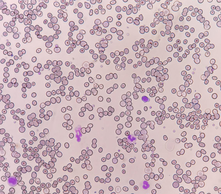 红细胞聚集导致的仪器法网织红细胞计数偏差一例