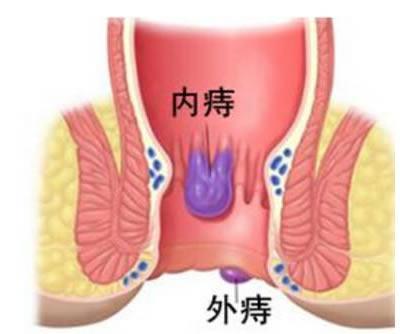 痔疮天然克星就在我们身边除了常见的花椒还有一物不可忽视消肉球不