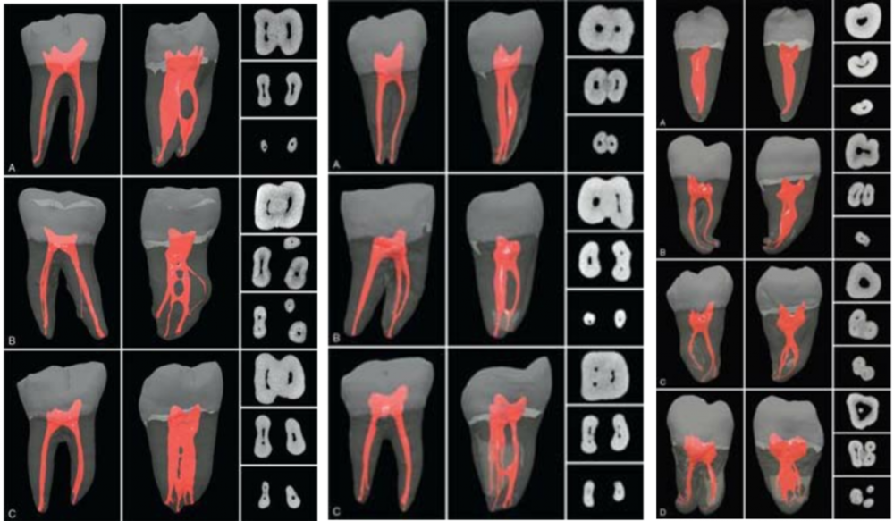根管形态复杂,包括根管侧支,根尖分歧,根尖分叉,根管峡部和严重弯曲根