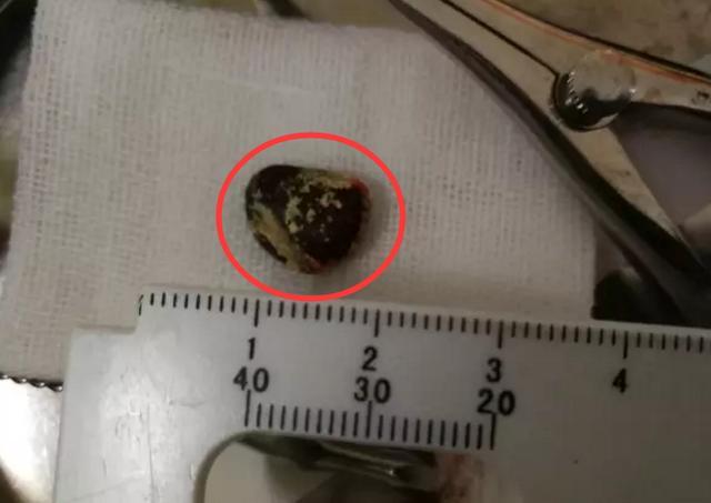 长沙3岁幼儿一直流鼻涕 鼻腔取出异物惊呆医生