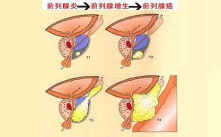 哪些情况说明前列腺增生需要治疗了