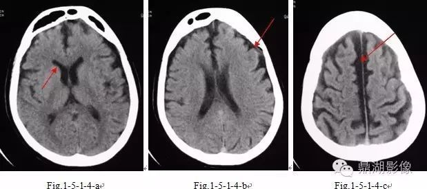ct颅脑平扫(fig.1-5-1-3-a-c)示:老年性脑萎缩(脑沟,脑池,脑室增大).