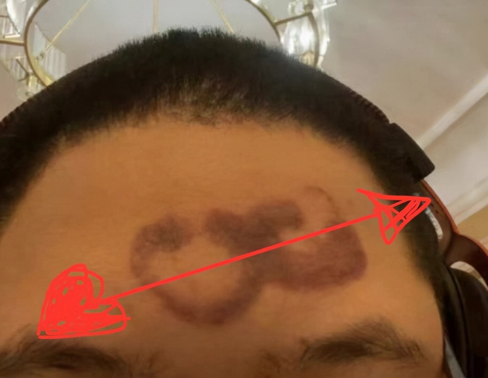 因拔罐用力过猛pdd正式宣布停播晒出脑门疤痕让粉丝哭笑不得