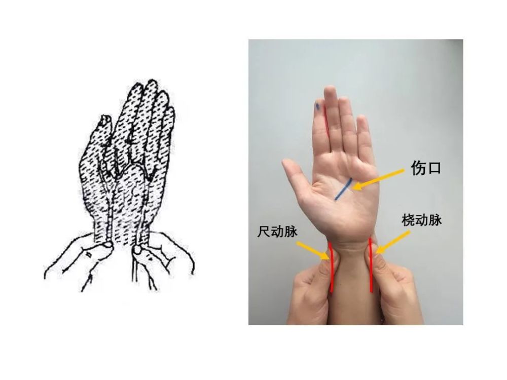 手部止血 压迫动脉:尺动脉和桡动脉 压迫点解剖位置:同侧手腕横纹稍上