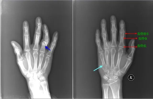 【影像诊断】左图:左侧第一指骨远节指骨骨折【影像诊断】右图:左侧