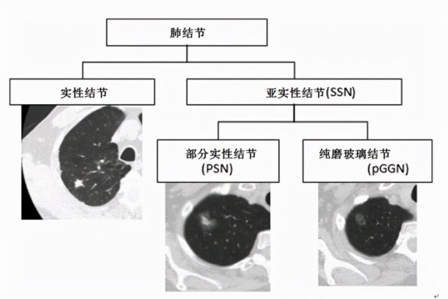 肺结节离肺癌到底有多远?90%以上的肺部小结节都不是肺癌