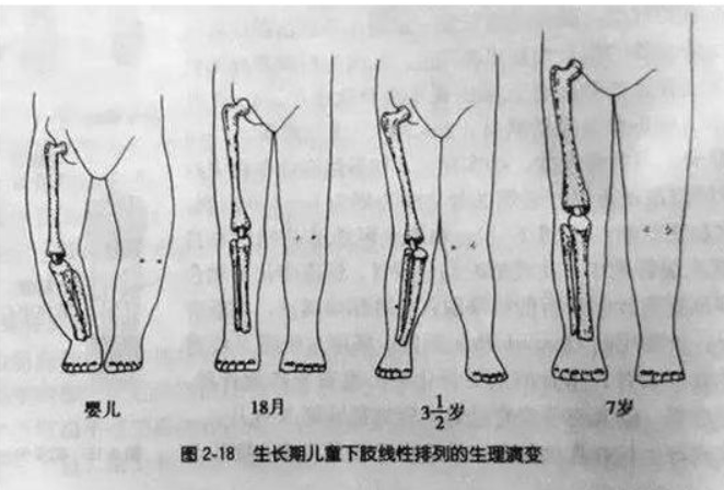 双踝并拢,双膝呈重叠状,那就可能是x型腿.父母要及时带宝宝看医生.