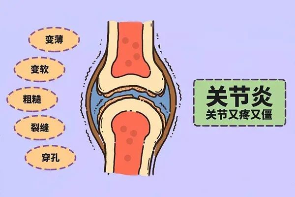 真相原来是这样|类风湿关节炎|膝关节|骨关节炎|膝关节炎|细胞