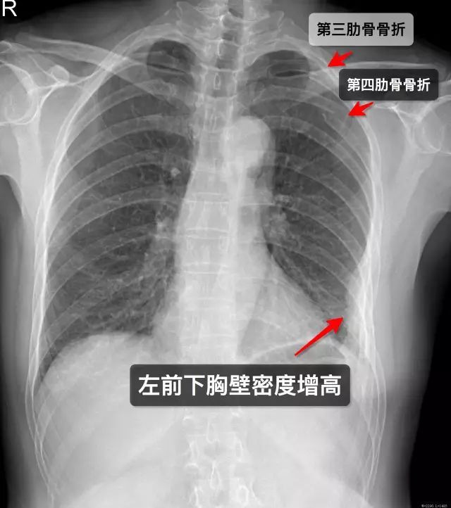 那些年,你漏诊过的肋骨骨折!