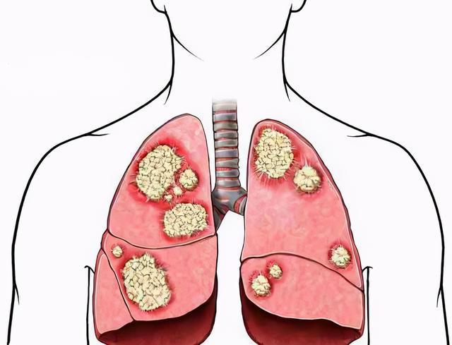 肺纤维化的症状和起因