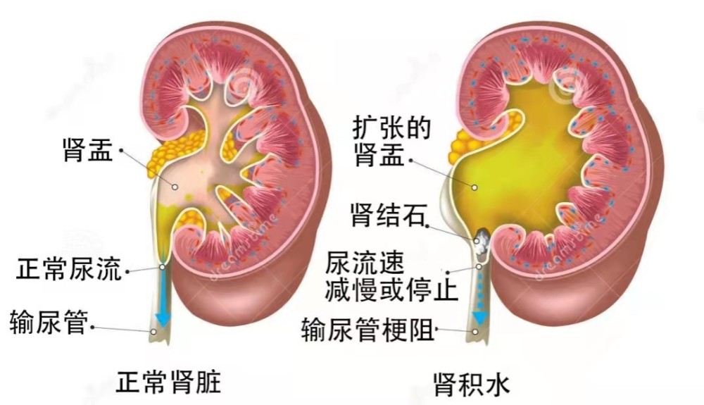 尿路结石的危害有哪些?