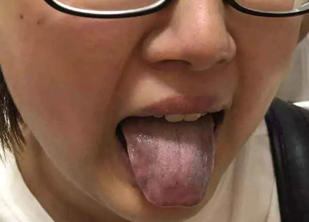 舌头上出现裂纹是什么原因?舌头有这3种现象,都在反映