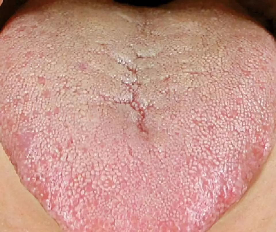 舌头上出现裂纹是什么原因舌头有这3种现象都在反映健康问题