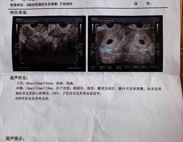 b超孕囊看男女提供三个数据立马知男女