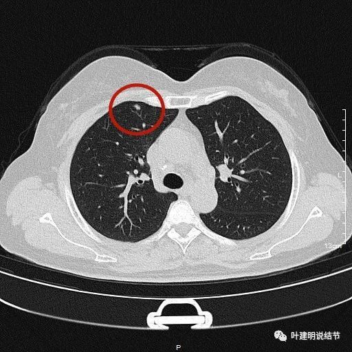 10.12:此消彼长的肺结节,会是恶性的吗?
