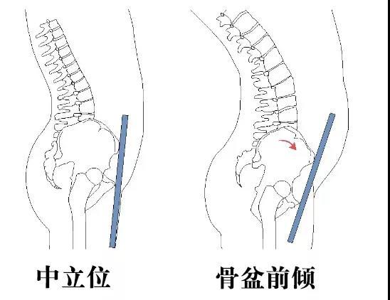 翘臀了,如果久坐久站会感到腰酸背痛,那有可能是被"骨盆前倾"给影响了