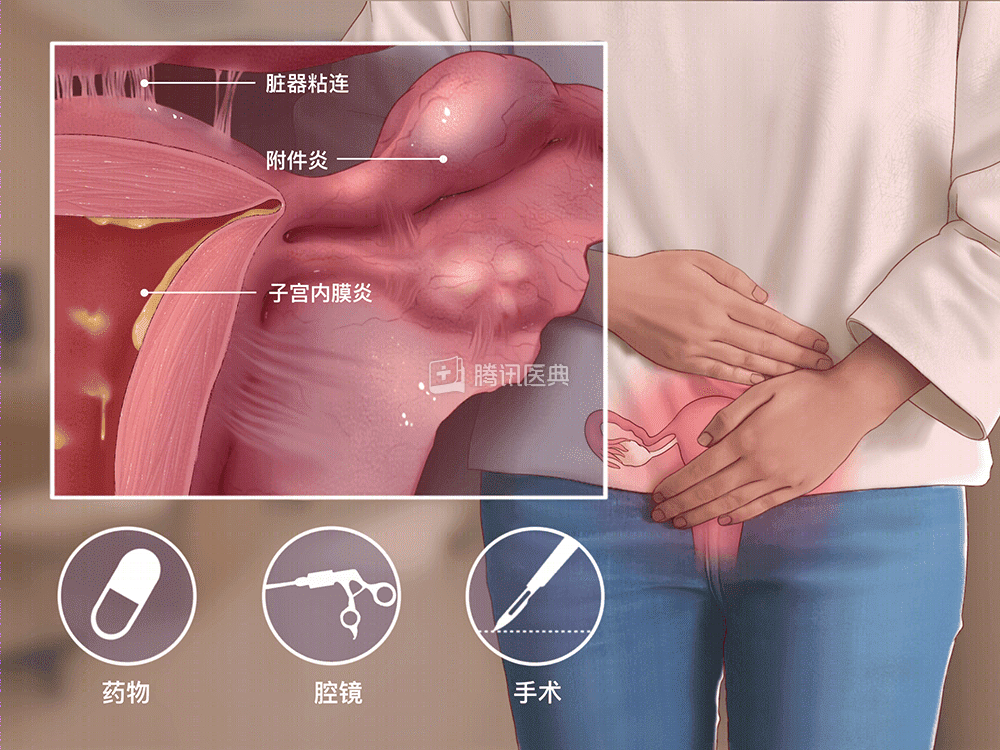 子宫内膜异位症(简称"内异症")