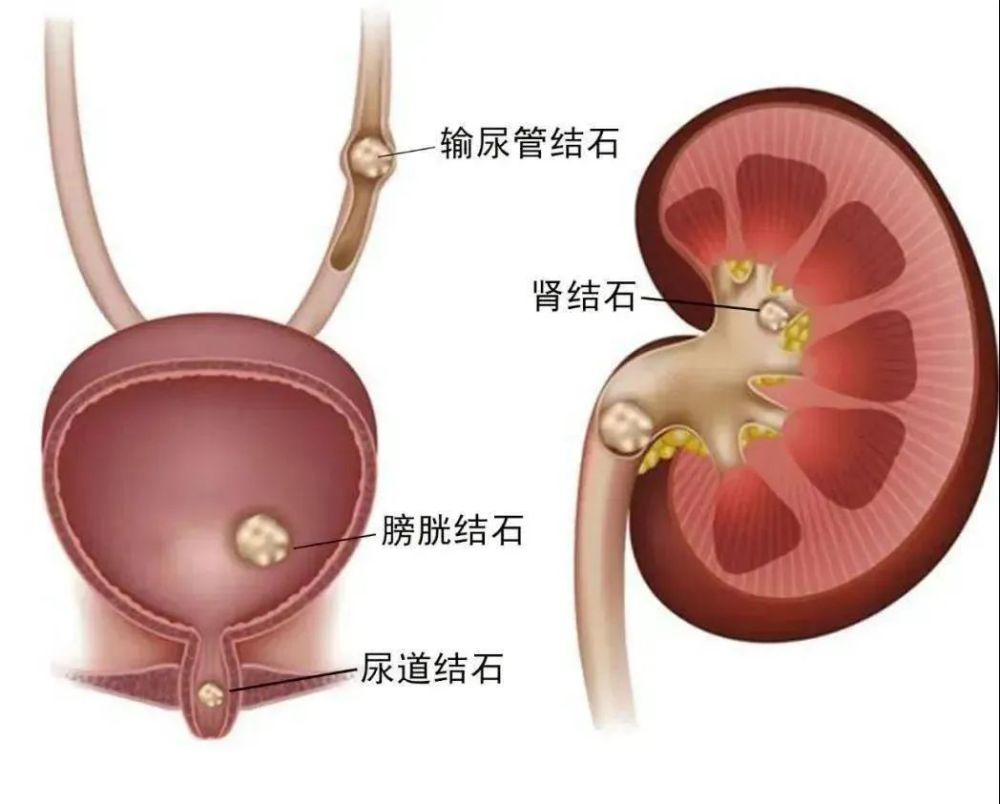 膀胱里取出近200颗结石小石头如何悄悄长进内脏里