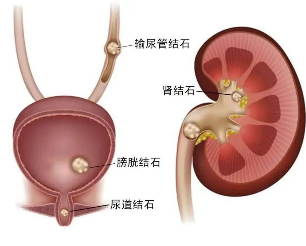 尿石症包括 肾结石,输尿管结石,膀胱结石和尿道结石,以肾和输尿管结石