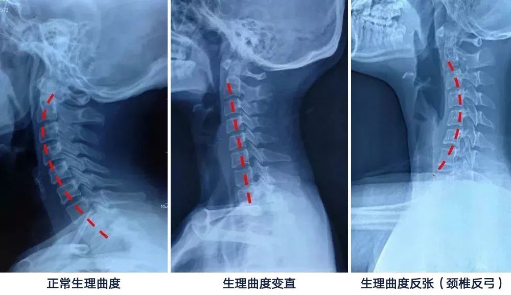 世界冠军的私用加特林3招放松颈椎按摩暖乎乎脖子都舒展了