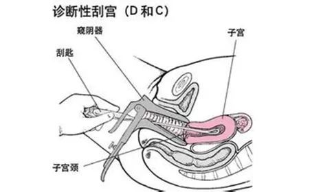 刮宫对女性身体的危害都有哪些