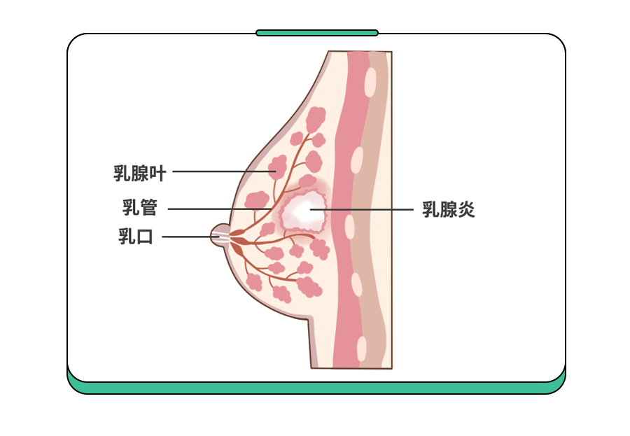 比生娃还痛!遭遇哺乳期乳腺炎,用这4招少受80%的罪!