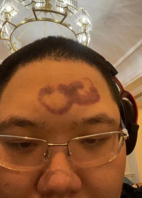 因拔罐用力过猛pdd正式宣布停播晒出脑门疤痕让粉丝哭笑不得