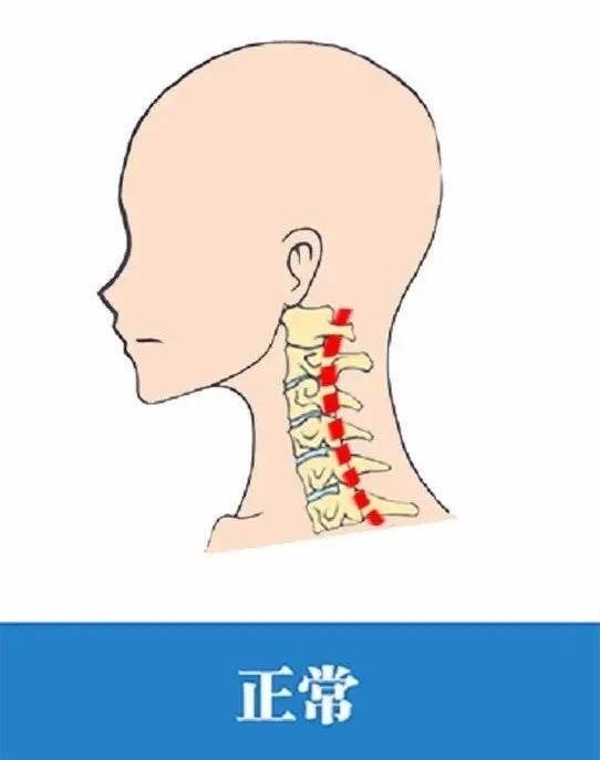 教你3招恢复颈椎生理曲度!