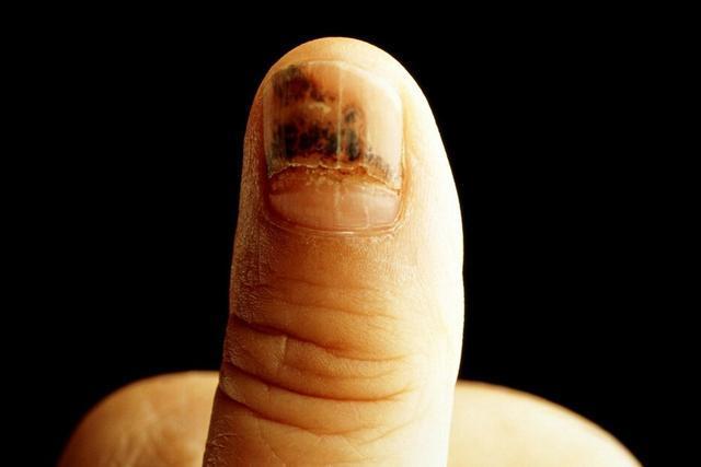 指甲有竖纹,横纹,淤青,月牙代表什么?几种指甲变化特征要了解